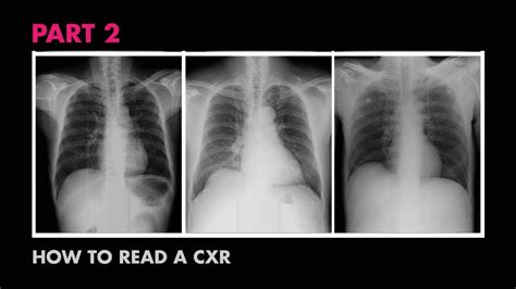 how to cheat chest x ray results|How to Read Your Chest X.